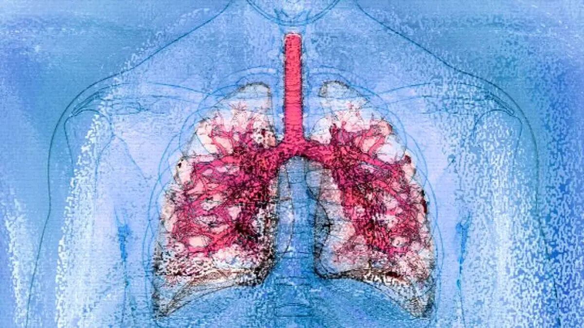 نخستین پیوند همزمان ریه و کبد میان دو فرد HIV مثبت 
