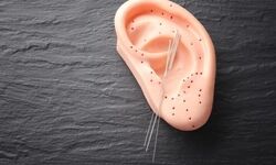 کاهش درد میگرن با طب سوزنی گوش