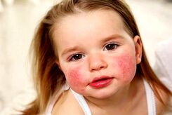 رازهای شکل‌گیری «حساسیت غذایی» در کودکان