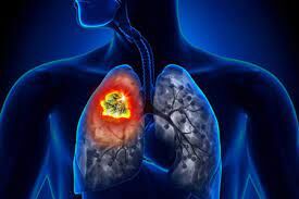 چگونه می‌توان سرطان ریه را زود تشخیص داد و درمان شد؟