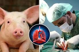 پیوند ریه خوک به انسان برای نخستین بار 
