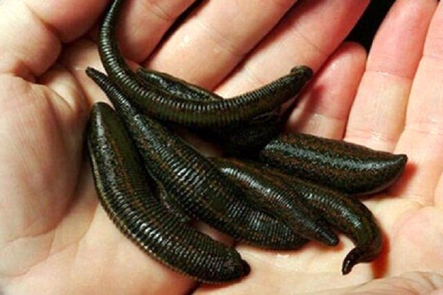 مقابله با بیماری پسوریازیس به کمک «زالو درمانی»