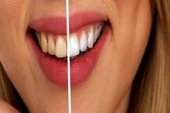 عوارض بلیچینگ دندان چیست و چگونه از آن پیشگیری کنیم؟