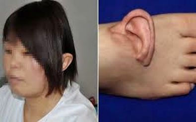 گوش برای اولین بار به پا پیوند زده شد 