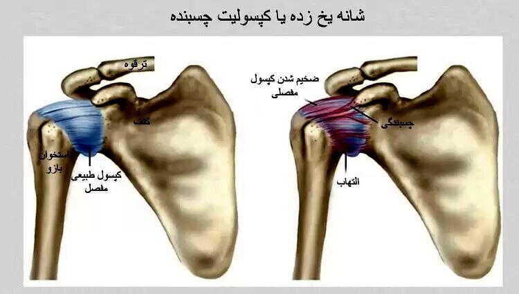آیا سرما باعث درد شانه می‌شود؟/ شانه یخ‌زده چیست؟/ این درد درمانی دارد؟