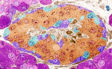 ویرایش ژن، امیدی تازه برای درمان دیابت نوع یک