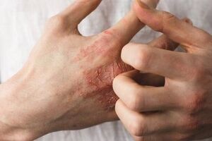 توصیه‌هایی درباره یک عارضه پوستیِ شایع