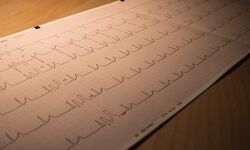 از سندرم مرگ ناگهانی بزرگسالان چه می‌دانید؟