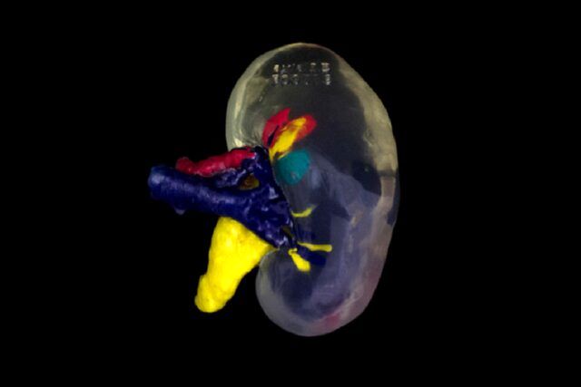 درمان هدفمندتر سرطان کلیه با کمک تومورهای چاپ سهبعدی