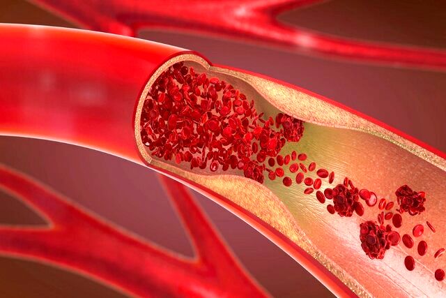 کاهش چشمگیر چربی خون با یک داروی جدید