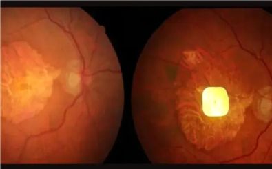 نابینایان با این ایمپلنت دوباره می‌توانند بخوانند
