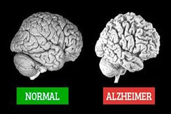 آلزایمر چیست، نشانه هایش کدام است و چه کنیم مبتلا نشویم؟ 