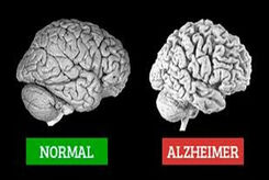 آلزایمر چیست، نشانه هایش کدام است و چه کنیم مبتلا نشویم؟ 