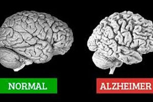 آلزایمر چیست، نشانه هایش کدام است و چه کنیم مبتلا نشویم؟ 