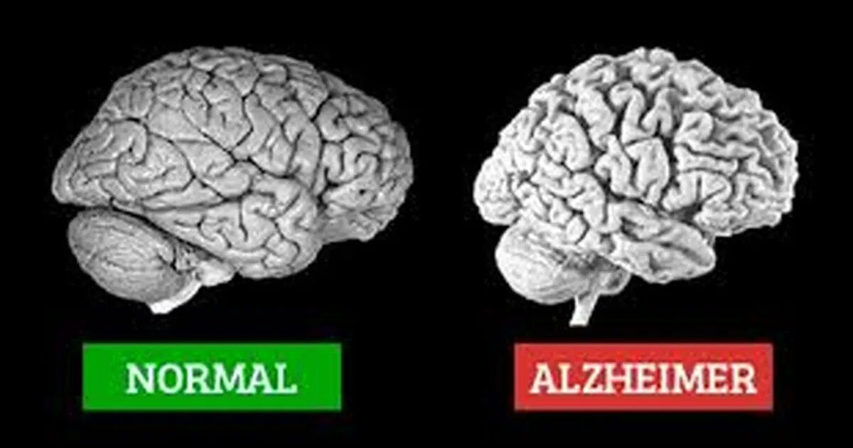 آلزایمر چیست، نشانه هایش کدام است و چه کنیم مبتلا نشویم؟ 
