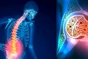 کدام خوراکی‌ها برای سلامت استخوان‌ها خطرناکند؟