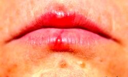 اشتباه مهلک در تشخیص آفت و تب‌خال؛ کدام‌یک مسری و خطرناک است؟