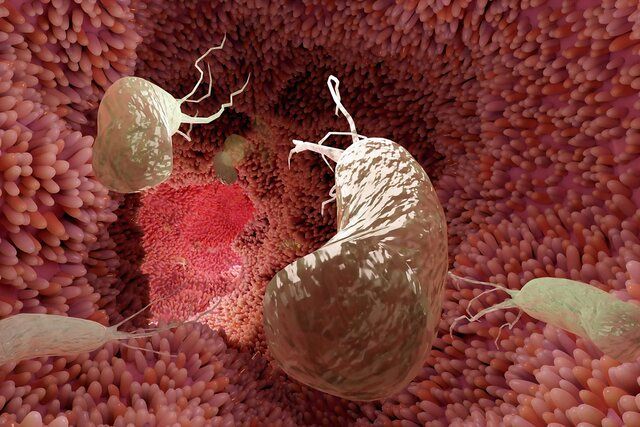 درمان ساده‌ای که می‌تواند از ۷۵ درصد سرطان‌های معده جلوگیری کند